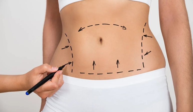 Tummy Tuck Abroad Guide