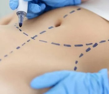 Tummy Tuck Abroad + Mommy Makeover